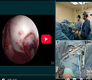 Live MACI Arthro: Rods & Cones System