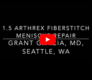 Meniscus Repair with new Fiberstitch
