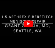 Meniscus Repair with new Fiberstitch