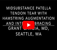 Midsubstance Patella Tendon Repair with Hamstring Augmentation
