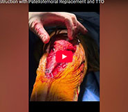 MQTFL Reconstruction with Patellofemoral Replacement and TTO
