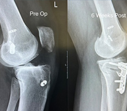 ACL repair preservation