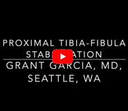 Proximal tib-fib stabilization using the cutting edge tightrope technique