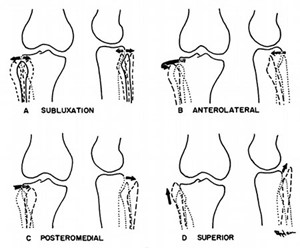 Proximal Tibiofibular Instability and Stabilization