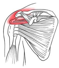 Rotator Cuff Tendonitis