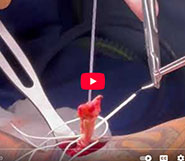 Updated Distal Biceps Fixation: New Arthrex Tension Tight Biceps Button