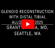 Updated Distal Tibial Allograft Glenoid Reconstruction Surgery