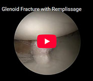 Updated Glenoid fracture repair with Remplissage in High Level Quarterback