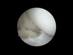 Complex anterior meniscus repair