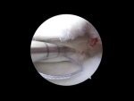 Complex vertical and horizontal meniscus repair