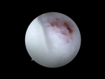 Dr. Garcia demonstrates first live MACI Arthro video in the US