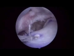 Dr. Garcia demonstrates his advanced technique for “over the top” rotator cuff repair ...
