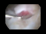 Dr. Garcia demonstrates his all suture technique for ACL repair and ACL tibial spine repai...
