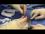 Dr. Garcia demonstrates his cartilage defect treatment using MACI.