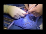 Dr. Garcia demonstrates his cutting edge technique for medial meniscus transplantation.