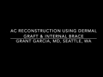 Dr. Garcia demonstrates his cutting edge technique for revision AC reconstruction surgery.