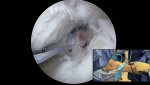 Dr. Garcia demonstrates his innovate technique for meniscal root repair.
