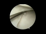 Dr. Garcia demonstrates his new technique to further improve meniscus root repair called c...