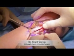 Dr. Garcia demonstrates his technique for elbow UCL repair with an internal brace.