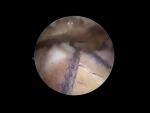 Dr. Garcia demonstrates the new cuffmend rotator cuff augmentation technique.