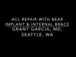Dr. Garcia’s BEAR ACL repair technique with an Internal Brace