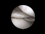 Dr. Garcia’s Hay Barrel Technique for Discoid Meniscus Repair
