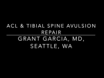Dr. Garcia’s newest technique to fix ACL tibial spine using the new ACL tightrope system