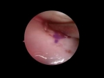Dr. Garcia’s updated technique for ACL with medialmeniscus transplant surgery