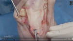 Dr.Garcia demonstrates his distal patella tendon repair technique