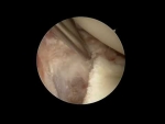 Dr.Garcia’s newest technique for arthroscopic glenoid fracture repair