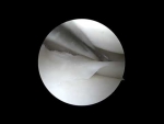 Meniscal Repair Using Fiberstitches 2025