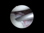 Updated Anterior Labral Repair 2024