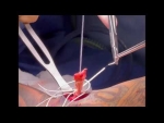 Updated Distal Biceps Fixation: New Arthrex Tension Tight Biceps Button