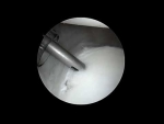 Updated MDI Surgery Technique
